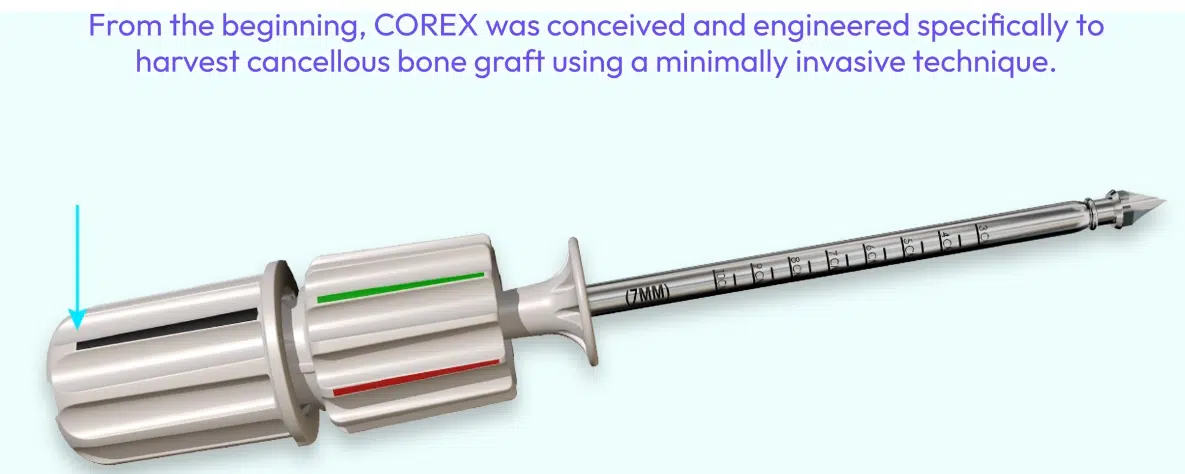 M.I.S. Harvesting Comparison - COREX